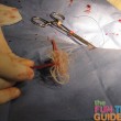 heartworms-removed-surgically